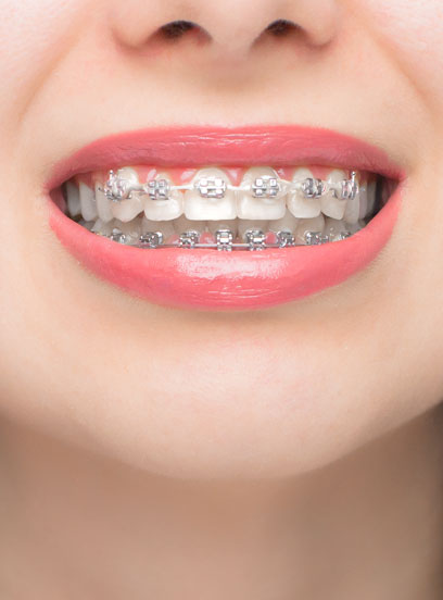 Fixed brace FAQs Fixed brace FAQs