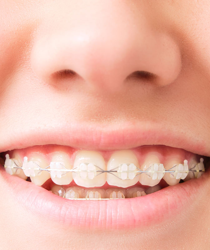 Clarity Advanced clear braces Clarity Advanced clear braces